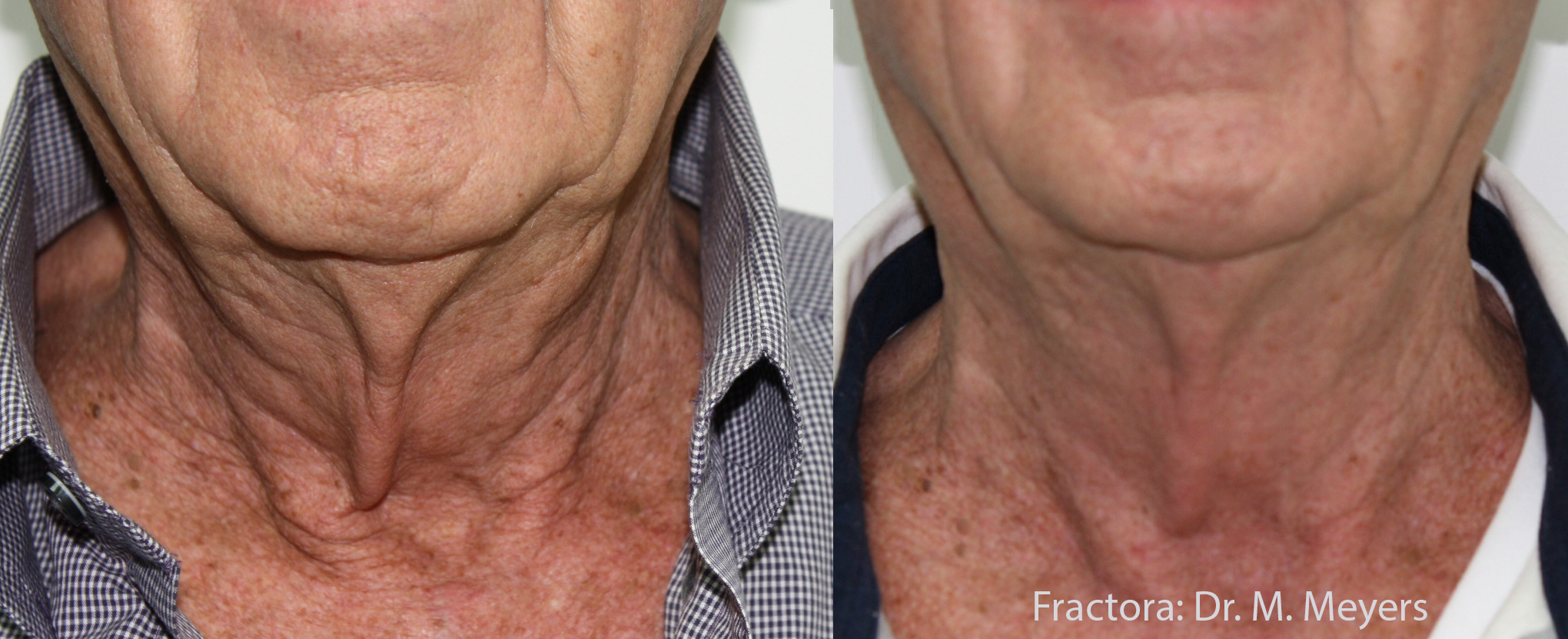 Micro Needling Fractora Radiofrequency Royal Tunbridge Wells UK